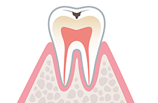 虫歯治療