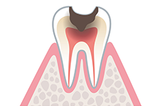 虫歯治療