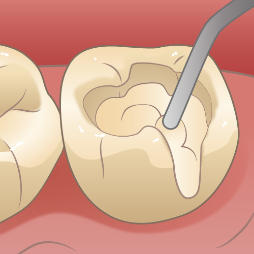 虫歯治療
