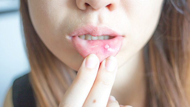 舌 を 噛む 口内炎