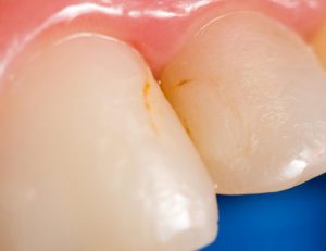 綾瀬（葛飾区）の歯医者、メリー歯科で歯の黒い線についての解説
