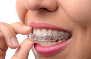 綾瀬（葛飾区）の歯医者、メリー歯科で歯ぎしり用マウスピースの正しい使い方とお手入れ方法を解説